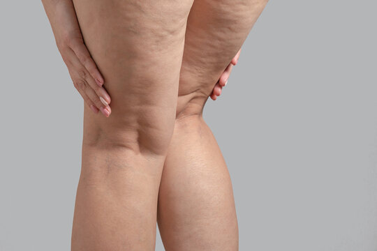 Stretch marks, cellulite and varicose veins on female legs. Copyspace