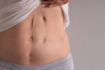 Multiple scars on woman's abdomen from surgery
