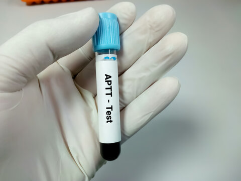 Blood Sample for Activated Partial Thromboplastin Time (APTT). Blood coagulation testing. Medical/health concept. PTT.