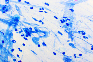 Mycobacterium tuberculosis positive (small red rod) in sputum smear, acid-fast stain, analyze by microscope 1000x