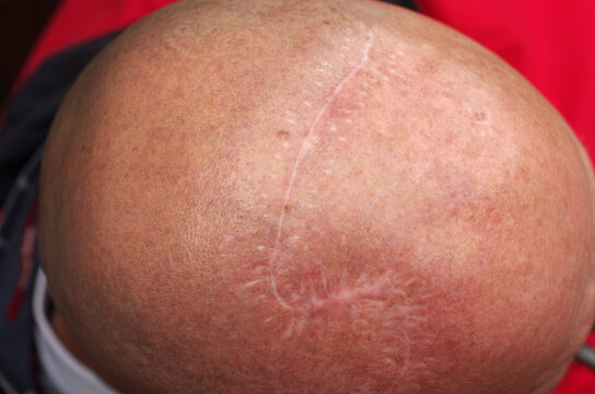 eine lange narbe &uuml;ber dem kopf nach einer operation