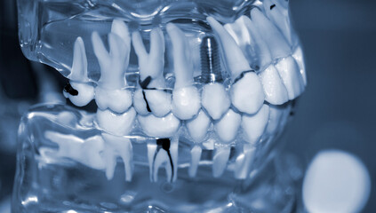 Transparent Model of Human Teeth with implants close-up.