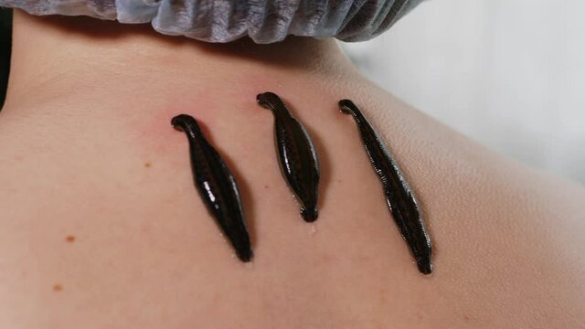 Three leeches on patient's neck, close-up. Hirudotheraphy concept. High quality 4k footage