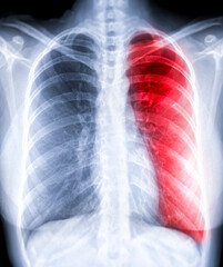 Chest X-ray or X-Ray Image Of Human Chest PA view showing  Tuberculosis (TB) and corona virus 2019 ( red zone ) .