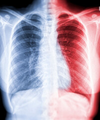 Chest X-ray or X-Ray Image Of Human Chest PA View  blue and red zone  for detect Tuberculosis (TB) and corona virus 2019  .