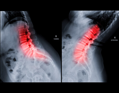 X-ray image of lumbar Spine lateral Flexion and Extension  view showing lower back pain.