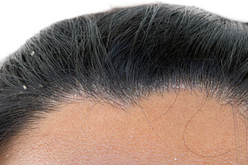 Man with dandruff in his hair on white background, closeup
