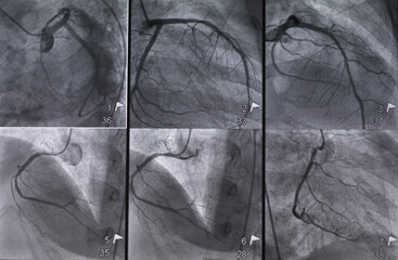 Coronary angiogram (CAG) was performed left and right coronary artery stenosis in multiple views.