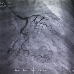 Coronary angiogram (CAG) was performed chronic total occlusion (CTO) at left coronary artery (LCA).