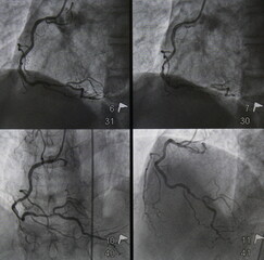 Coronary angiogram (CAG) was performed right coronary artery (RCA) stenosis in multiple views.
