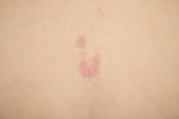 Fototapeta premium birthmark on the skin, red nevus close up.