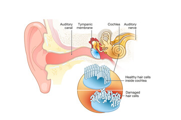 Tinnitus, healthy and damaged hair cells - obrazy, fototapety, plakaty
