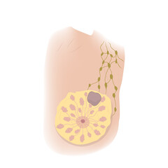 Woman breast disorders. Fibroadenoma. Medical vector illustration.