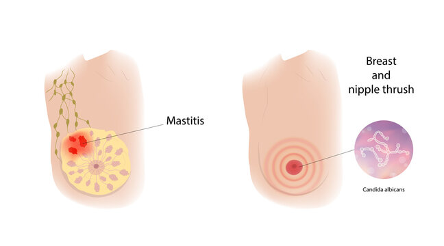 Woman breast. Mastitis and breast and nipple thrush. Comparison. Medical vector illustration.