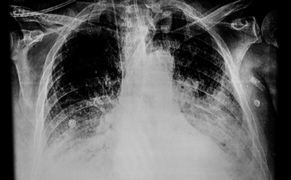 Chest X- Ray Showing A Patient With Tracheostomy Tube, COVID Lung Infection And Central Venous Line