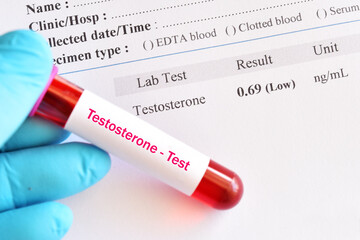 Abnormal low testosterone hormone test result with blood sample tube
