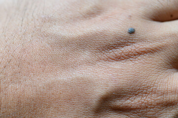 Naklejka premium Hand back skin with deep groove texture and mole