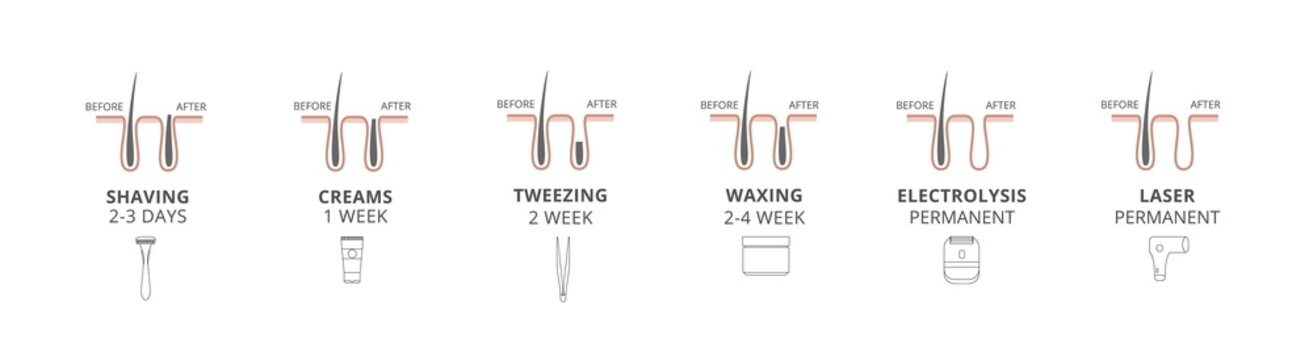 Hair removal methods - laser and shaving, creams and tweezing, waxing and electrolysis. Procedure of beauty before and after effects for skin body. Set of vector illustrations.