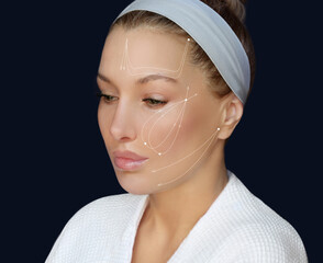 Thread Lift ,markup, thread-lift procedure for facial rejuvenation.