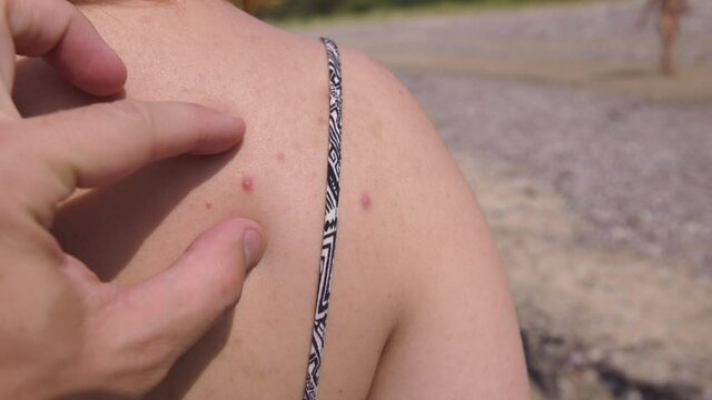 Male hand tries to pop pimple on female back at beach