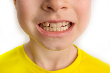 Little girl stands on a white background with a beautiful smile, children crooked teeth, pediatric...