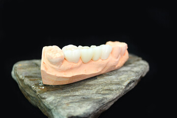 Dental zirconia bridge with all porcelain