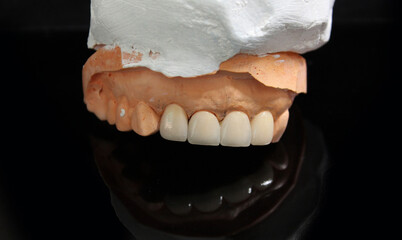 New veneers for patient. smile makeover.