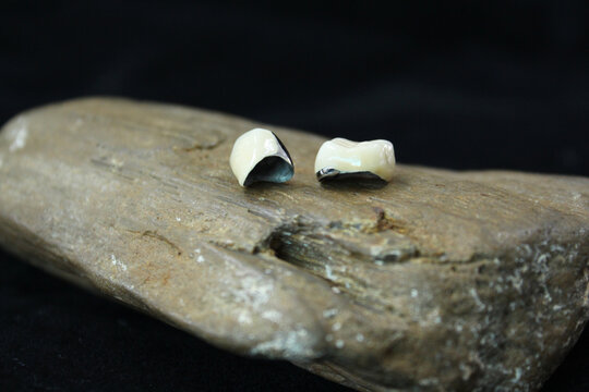PFM dental crown for patient. 