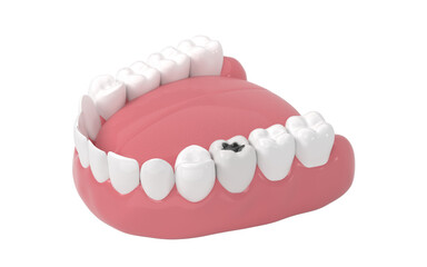 Tooth decay, unhealthy teeth, 3d rendering.