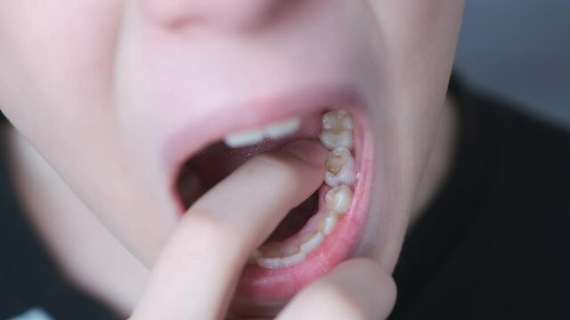 Baby tooth in mouth of a ten-year-old boy, he sways it with his finger, closeup view of open mouth. Change of teeth in a teenager. Stomatology, dentistry concept for child.