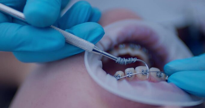 Close-up open mouth with optragate and on the teeth is a bracket system and a medical hand is taking out a stainless steel archwire broad form from upper jaw by using a dental probe.