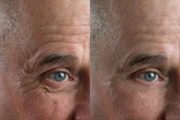 Before and after cosmetic operation. close-up of eyes and forehead of old man, senior with wrinkles...