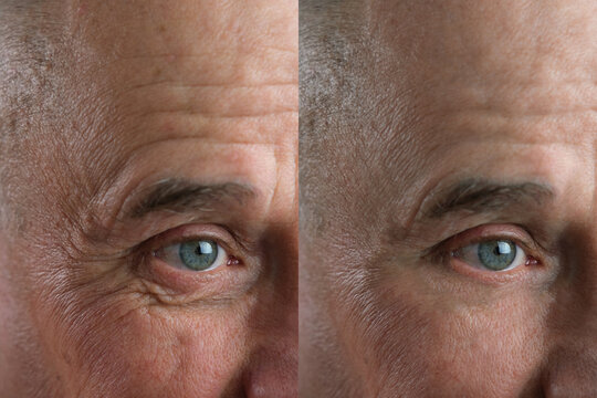 Before and after cosmetic operation. close-up of eyes and forehead of old man, senior with wrinkles on his face in two versions, wrinkles on face, overhang, concept of cosmetic anti-aging procedures,