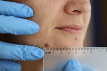 Dark wart on woman's face with ruler - obrazy, fototapety, plakaty