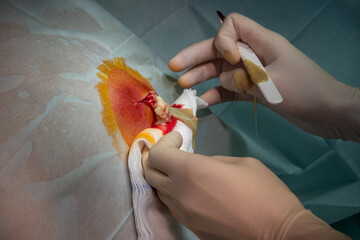 in the operating room the abscess of a patient is operated by a doctor