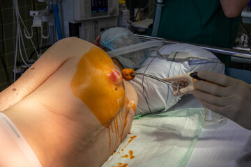 in the operating room the abscess of a patient is operated by a doctor