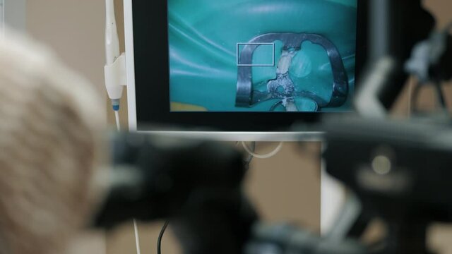 View of the monitor screen during the dental procedure, treatment to a patient through a microscope, teeth close up
