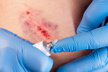 Doctors hands in gloves performs the treatment the wound with the help of ointment. Hematoma of...