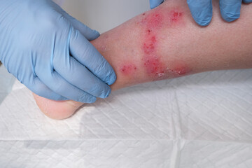 close-up of human shin, doctor treats numerous wounds on leg of an adult female patient, redness,...