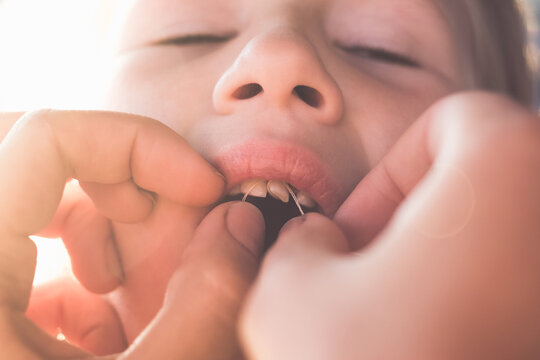The process of removing a baby tooth using a thread