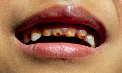 Dental caries on a child, in front teeth. Dental care concept