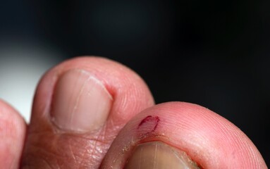 A wound on the big toe, dry skin and cracking skin