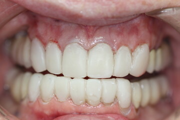 Fototapeta premium new teeth for the patient. new smile. match the color with the teeth. 