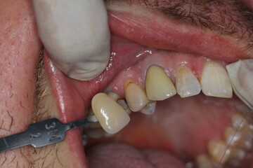 new teeth for the patient. new smile. match the color with the teeth. 