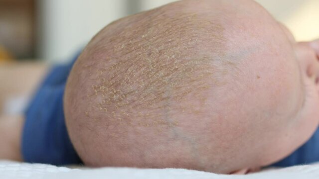seborrhea dermatitis or cradle cap crusts on baby infant scalp 