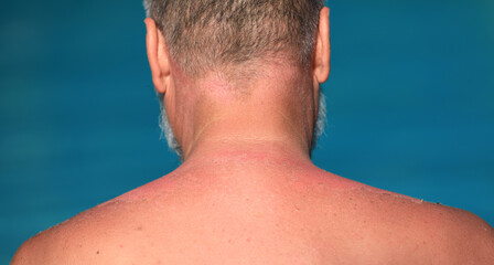 burn tan on the back of a man