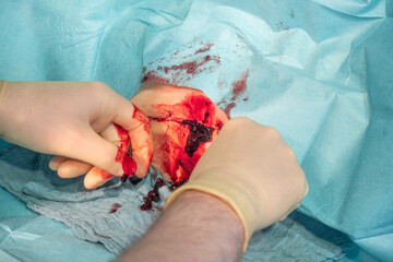 in the operating room a hematoma of a patient is operated by a doctor