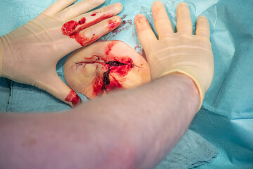 in the operating room a hematoma of a patient is operated by a doctor