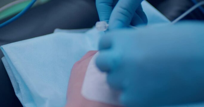 Close-up a female hand with an intravenous catheter inside of her hand and a medical worker is connecting the system to the catheter. 