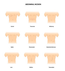 Abdominal Incision. Different types of abdominal incision. Surgery incision   - obrazy, fototapety, plakaty